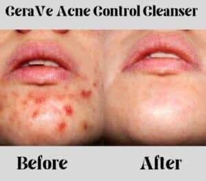 CeraVe Acne Control Cleanser pore cleansing solution 2024