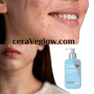 CeraVe Psoriasis Cleanser soothe and renew your skin 2024