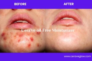 Best moisturizer for acne skin in 2025