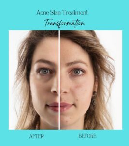 Acne control cleanser in 2025