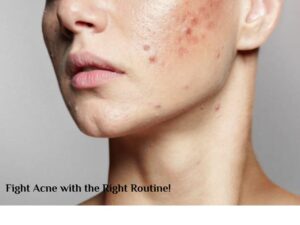 CeraVe Products for Acne-Prone Skin